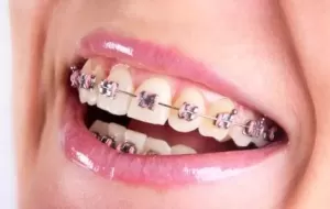 How To Care For Braces