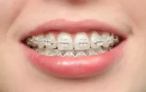 How Do Orthodontics Work?