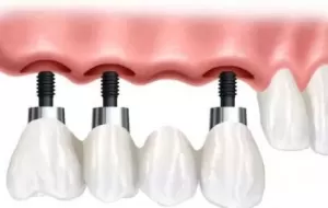 How Are Dental Implants Performed?