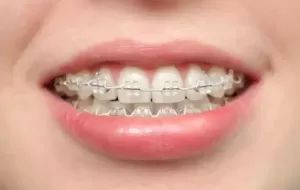 How Do I Know If I Need Braces?