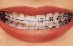 How Do I Relieve Braces Pain?