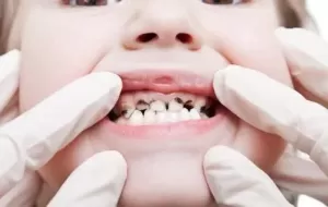 How Do I Protect My Teeth From Decay?