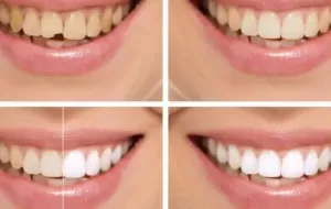 How Do I Whiten My Teeth?