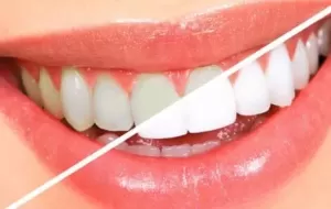 Benefits And Harms Of Teeth Whitening