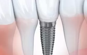 Disadvantages Of Dental Implants