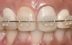 Disadvantages Of Transparent Braces