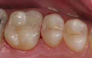 Dental Filling Method