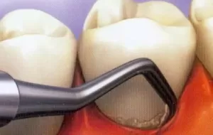 How To Clean Gums