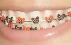 How To Install Braces