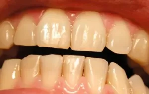 What Causes Yellowing Of Teeth?