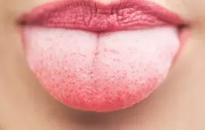 How To Remove The White Layer On The Tongue