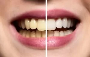 How To Make Teeth White